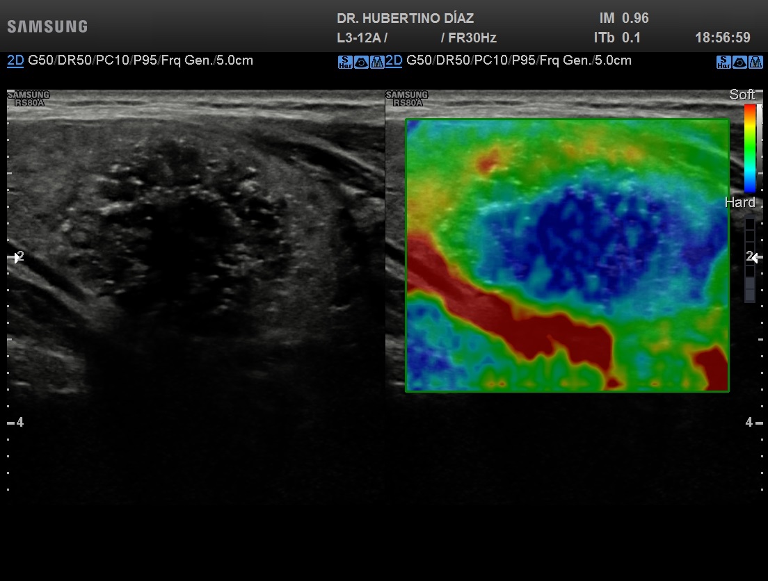 DRENAJE Y ALCOHOLIZACIÓN CON GUÍA ECOGRÁFICA (ESCLEROSIS)