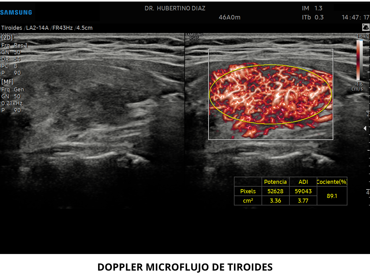 ECOGRAFÍA DOPPLER DE TIROIDES