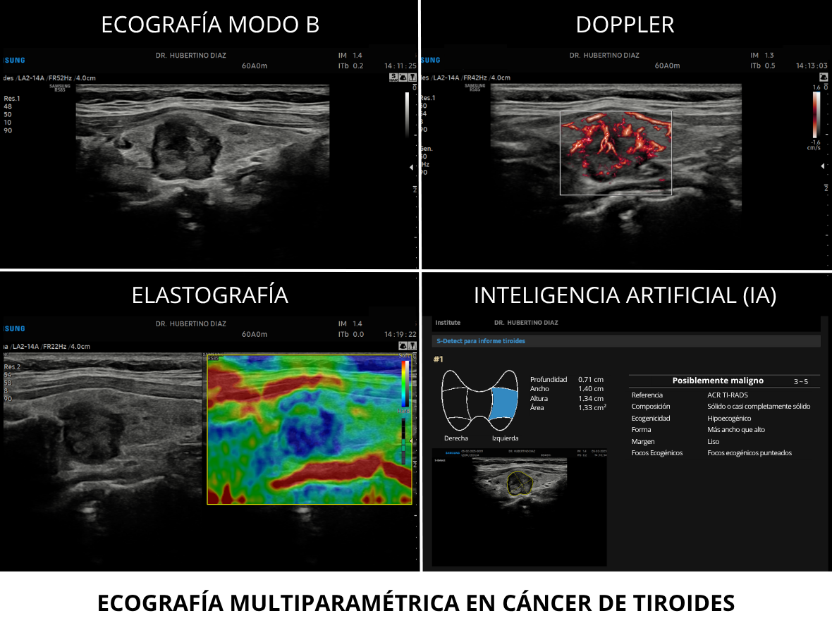 ECOGRAFÍA MULTIPARAMÉTRICA DE TIROIDES