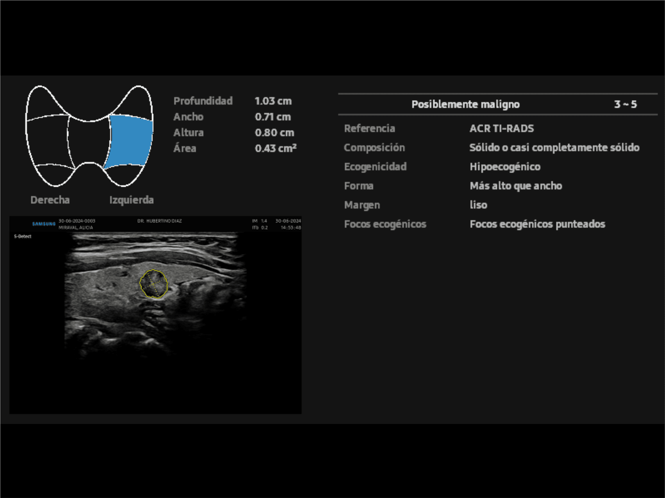 ECOGRAFÍA DE TIROIDES CON INTELIGENCIA ARTIFICIAL